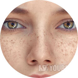Facial Freckles